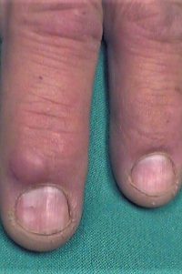 Ganglion cyst on finger below nail next to normal finger