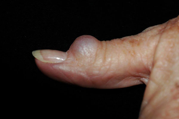 thumb with large ganglion cyst