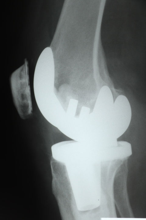 xray of knee after full knee replacement surgery