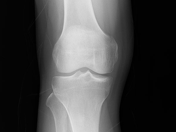 xray of normal knee