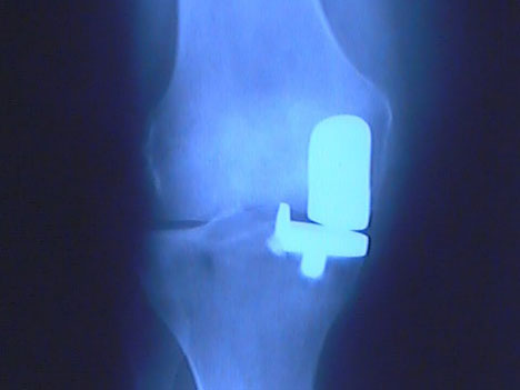 xray of partial knee replacment