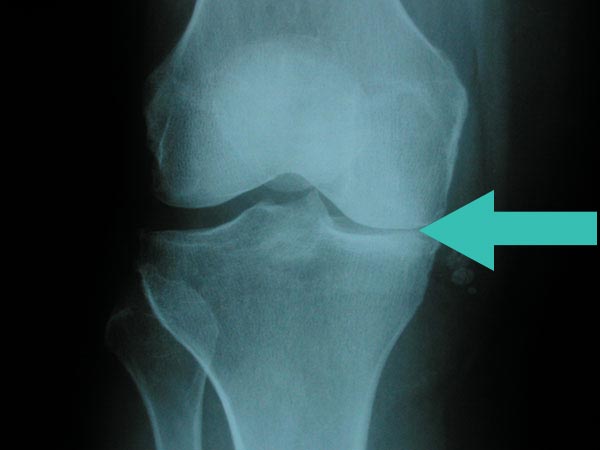 Xray of knee with advanced arthritis. Arrow pointing to bone-on-bone