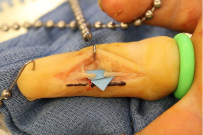 nerve damage on sliced finger cut with utility knife